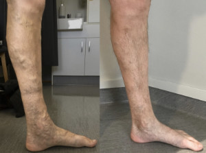 TISOX for varicose veins